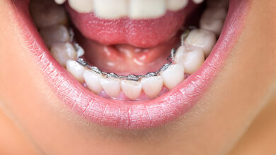 How to Get Teeth Straight – Cosmetic Dentistry Options